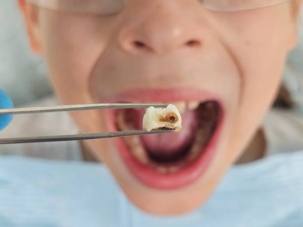 Best Emergency Tooth Extraction in Bloomington, CA